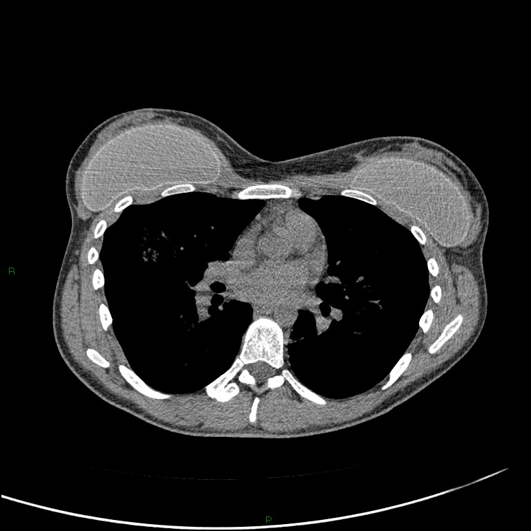 Idiopathic pulmonary hemosiderosis | Image | Radiopaedia.org