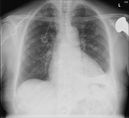 Pulmonary metastases | Radiology Reference Article | Radiopaedia.org