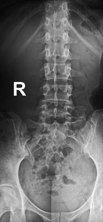 Bertolotti syndrome | Radiology Case | Radiopaedia.org