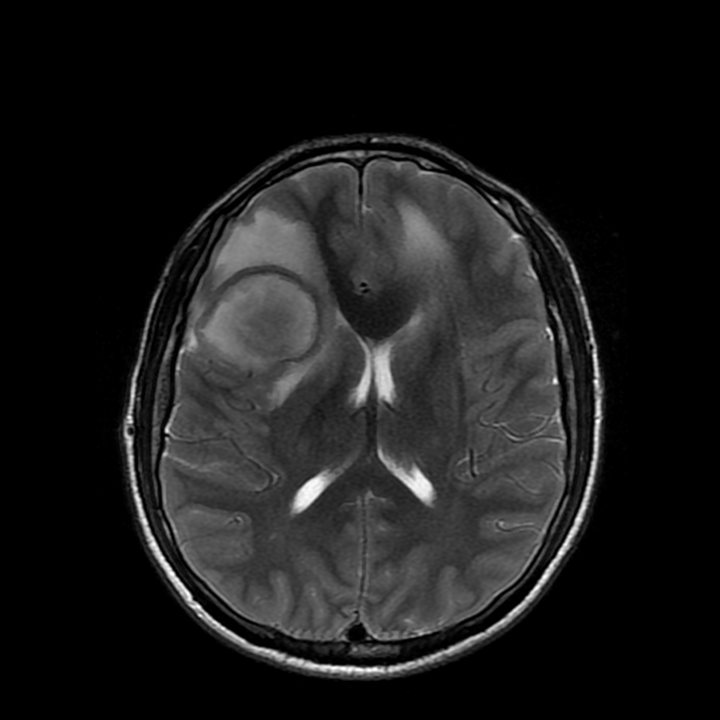 Cerebral abscesses | Image | Radiopaedia.org