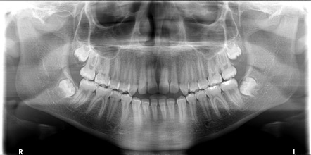 Macrodontia | Radiology Reference Article | Radiopaedia.org