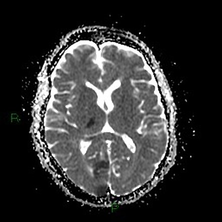 Hyperdense PCA sign and artery of Percheron infarct | Image ...