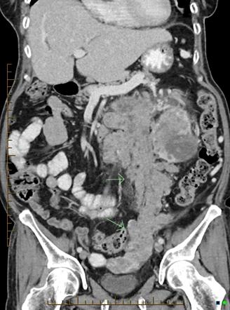 Ovarian vein invasion by renal cell carcinoma | Radiology Case ...