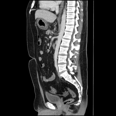 Ménétrier disease | Image | Radiopaedia.org