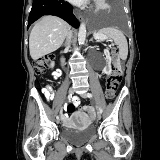 Gastric Metastases From Breast Cancer Linitis Plastica Image Radiopaedia Org