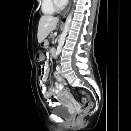 Gastric metastases from breast cancer (linitis plastica) | Image ...