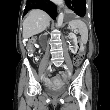 Gastric Metastases From Breast Cancer Linitis Plastica Image Radiopaedia Org