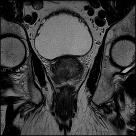 Prostate adenocarcinoma: PIRADS 5 | Image | Radiopaedia.org