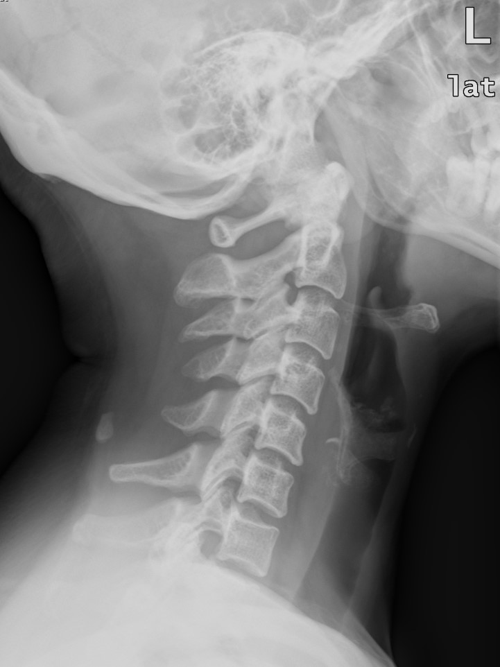 Nuchal ligament ossification | Image | Radiopaedia.org