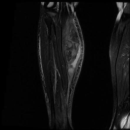 Gastrocnemius muscle medial head tear | Image | Radiopaedia.org