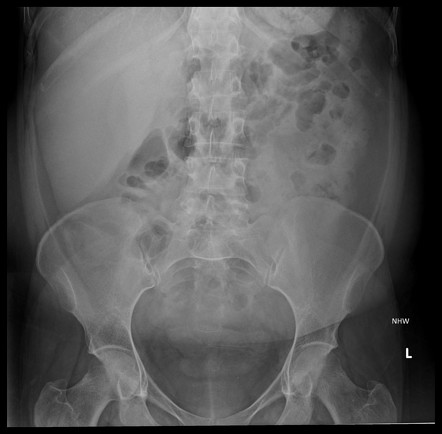 Hepatomegaly | Radiology Reference Article | Radiopaedia.org