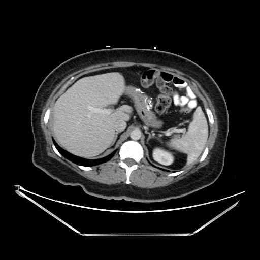 File:Petersen defect internal hernia, roux-en-y gastric bypass ...