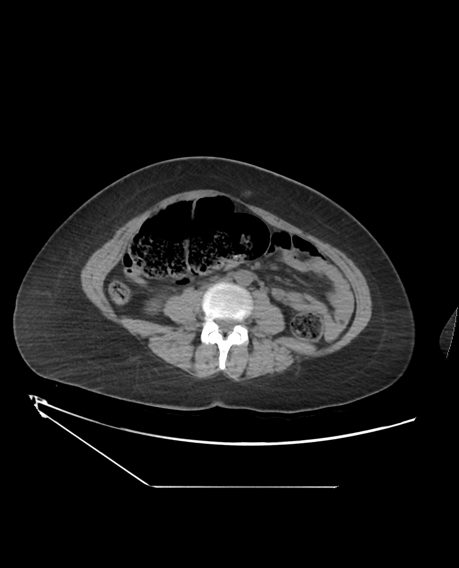 Cecal bascule | Image | Radiopaedia.org