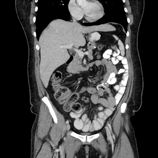 File:Petersen defect internal hernia, roux-en-y gastric bypass ...