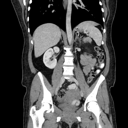 File:Petersen defect internal hernia, roux-en-y gastric bypass ...