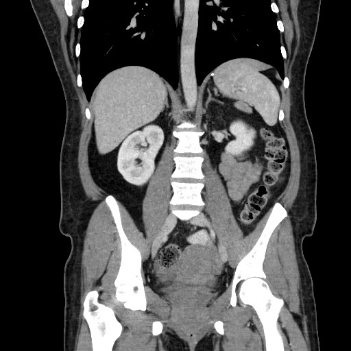 File:petersen Defect Internal Hernia, Roux-en-y Gastric Bypass 