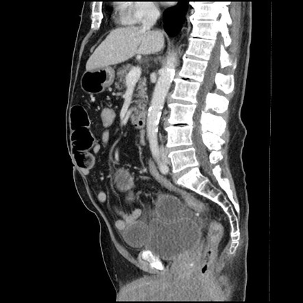 Closed loop small bowel obstruction due to adhesive band - U-shaped ...