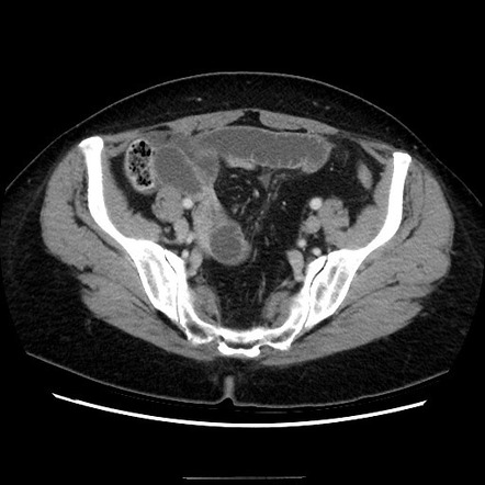 Closed loop obstruction | Radiology Reference Article | Radiopaedia.org