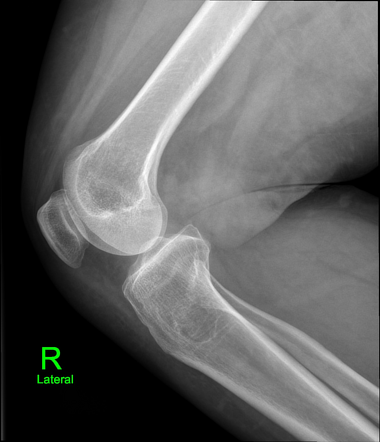 Intraosseous ganglion cyst | Image | Radiopaedia.org