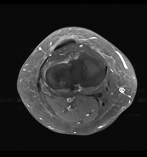 Intraosseous Ganglion Cyst Image 5562