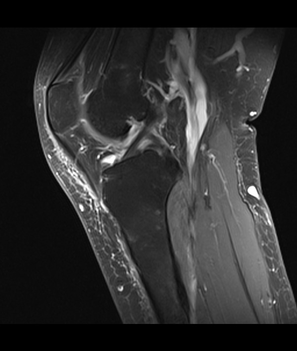 Intraosseous ganglion cyst | Image | Radiopaedia.org