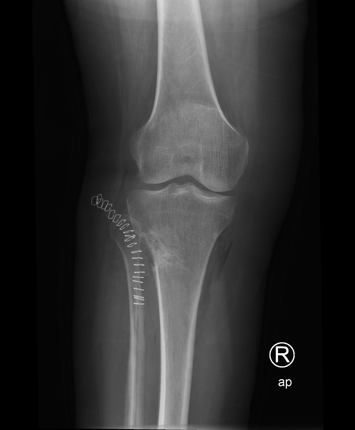 Intraosseous ganglion cyst | Image | Radiopaedia.org