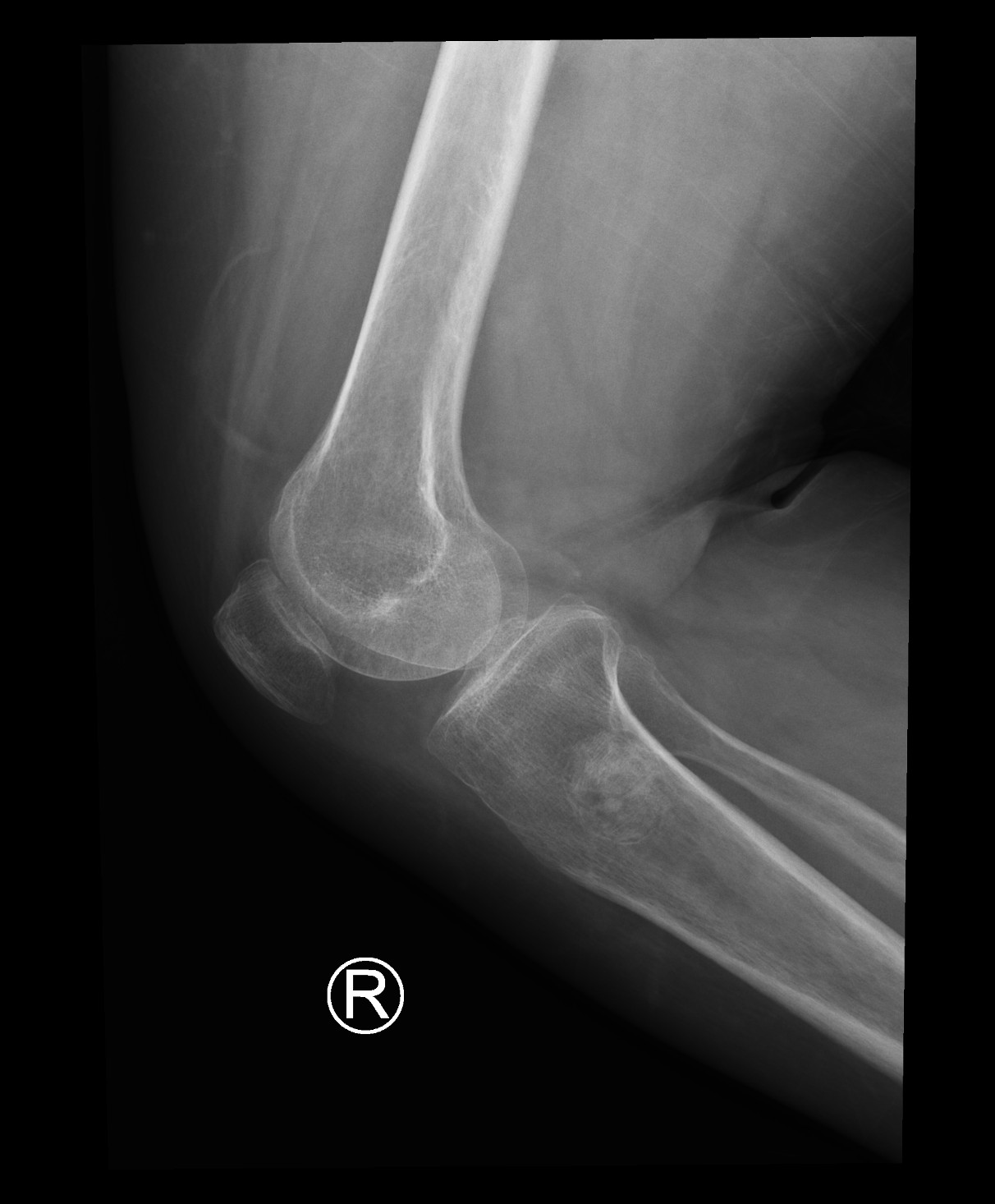 Intraosseous ganglion cyst | Image | Radiopaedia.org