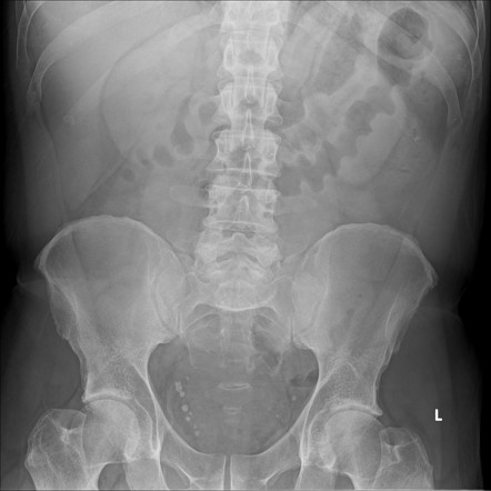 Thumbprinting | Radiology Case | Radiopaedia.org