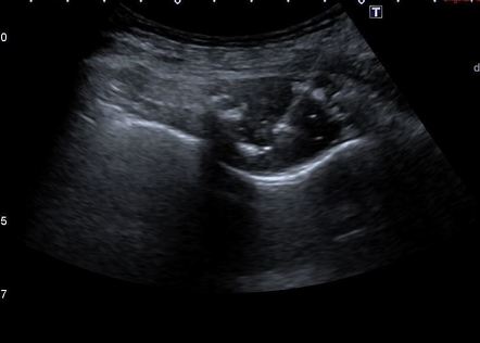 Ultrasound guided biopsy of rib metastasis | Radiology Case ...