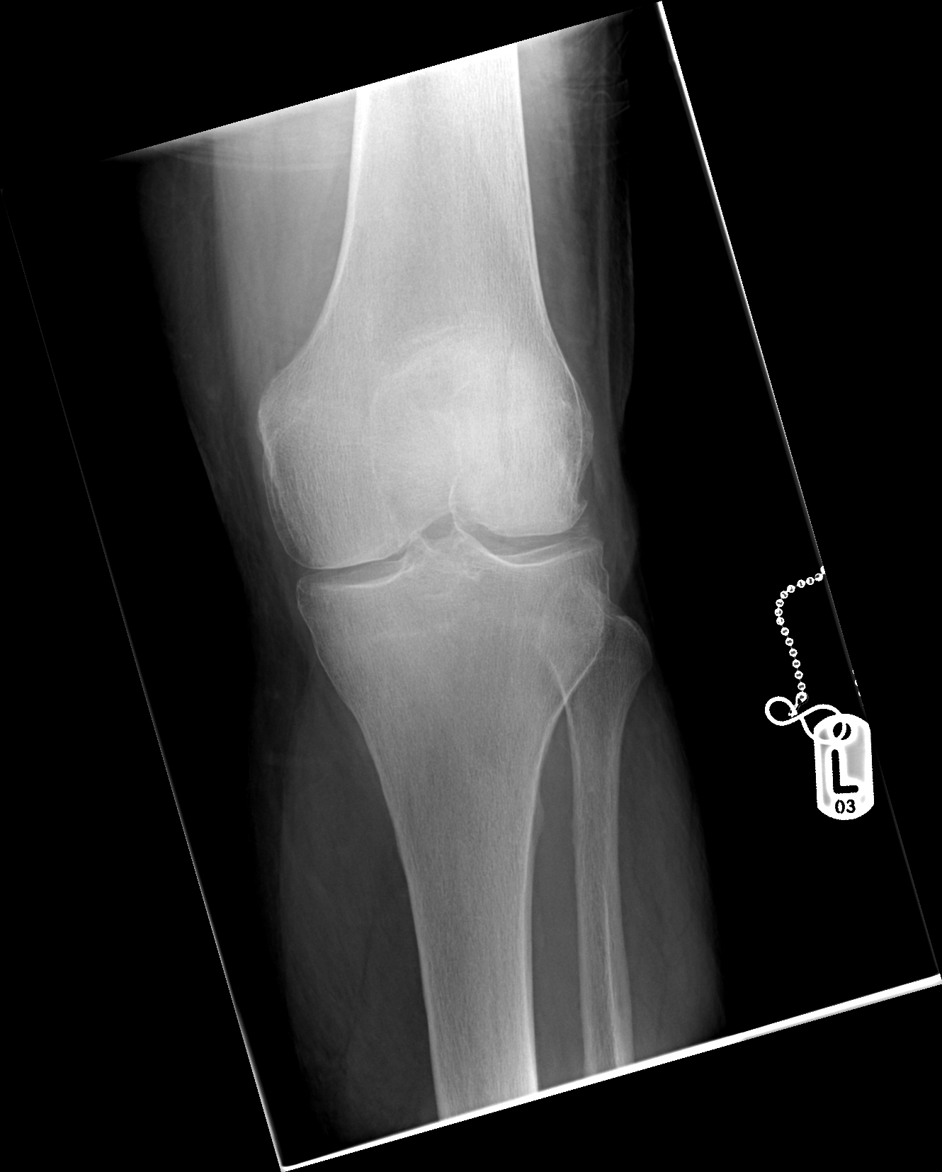 Patella Fracture Image