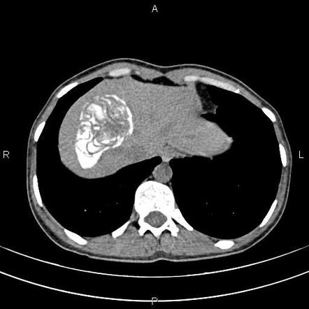 Calcified hepatic hydatid cyst | Radiology Case | Radiopaedia.org