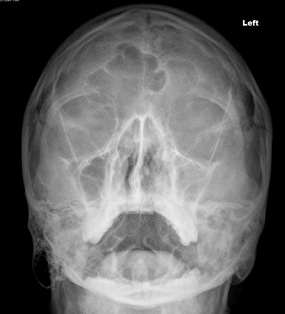 Deviated Septum X Ray