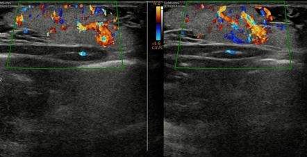 Infantile Hemangioma Ultrasound