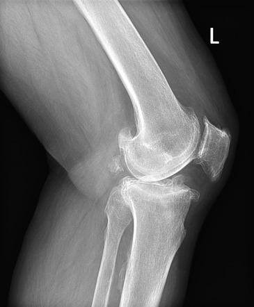 Knee joint osteoarthritis | Image | Radiopaedia.org