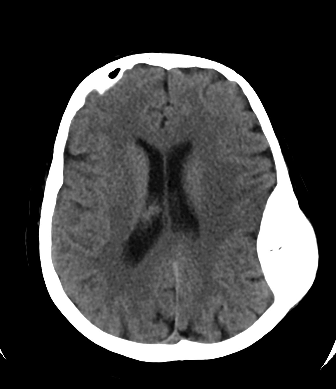 Skull vault hemangioma | Image | Radiopaedia.org