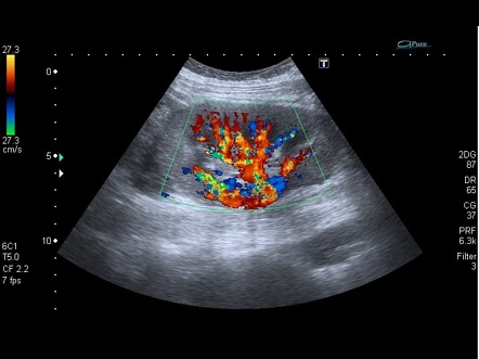 Renal transplant | Radiology Reference Article | Radiopaedia.org