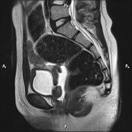 Vesicovaginal fistula | Radiology Case | Radiopaedia.org