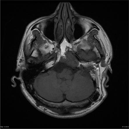 Clival chordoma | Image | Radiopaedia.org