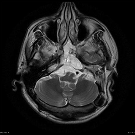 Viewing playlist: neuro viva | Radiopaedia.org