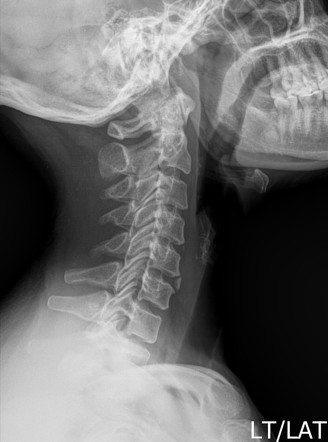 Cervical intercalary bone | Radiology Case | Radiopaedia.org