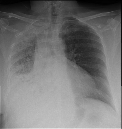 Migrating airway foreign body | Radiology Case | Radiopaedia.org