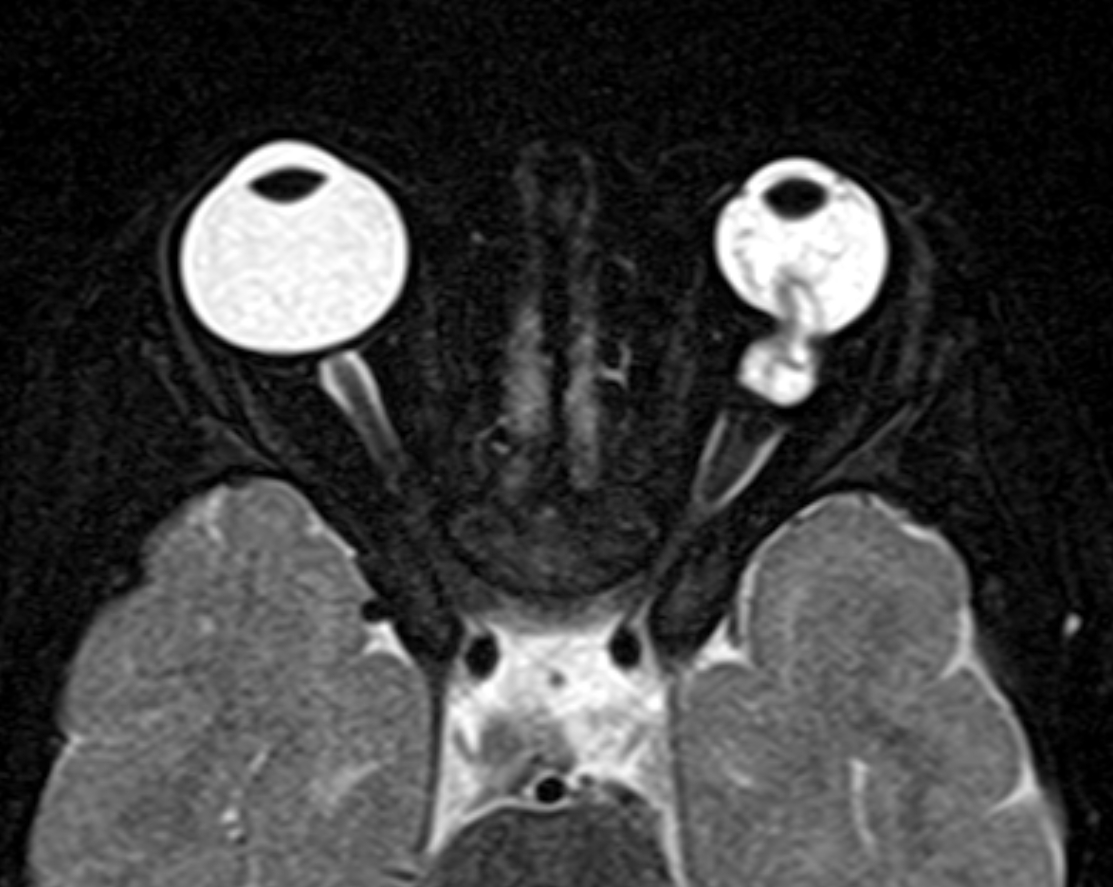 Coloboma with vitreous hemorrhage | Image | Radiopaedia.org