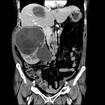 Ruptured renal hydatid cyst | Radiology Case | Radiopaedia.org