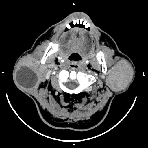 Bilateral Warthin tumors | Image | Radiopaedia.org