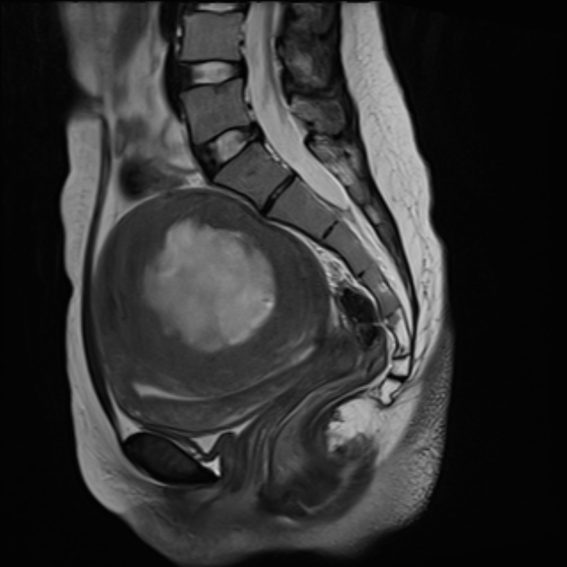 Cystic degeneration of a leiomyoma | Radiology Reference Article ...