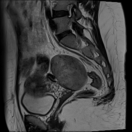 Ovarian Fibroma Radiology Case Radiopaedia Org