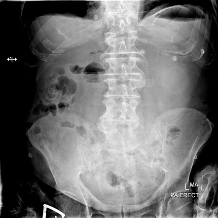 Gallstone ileus | Radiology Case | Radiopaedia.org