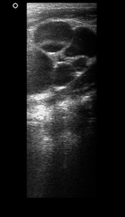 Hydronephrosis | Radiology Reference Article | Radiopaedia.org