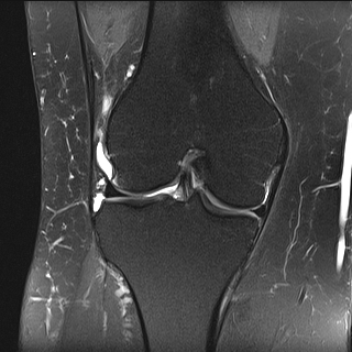 Acute-on-chronic transient lateral patellar dislocation with trochlear ...