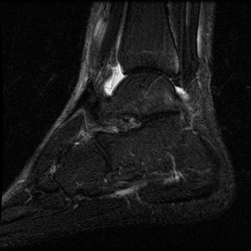 Syndesmotic And Collateral Ankle Ligament Injuries | Image ...